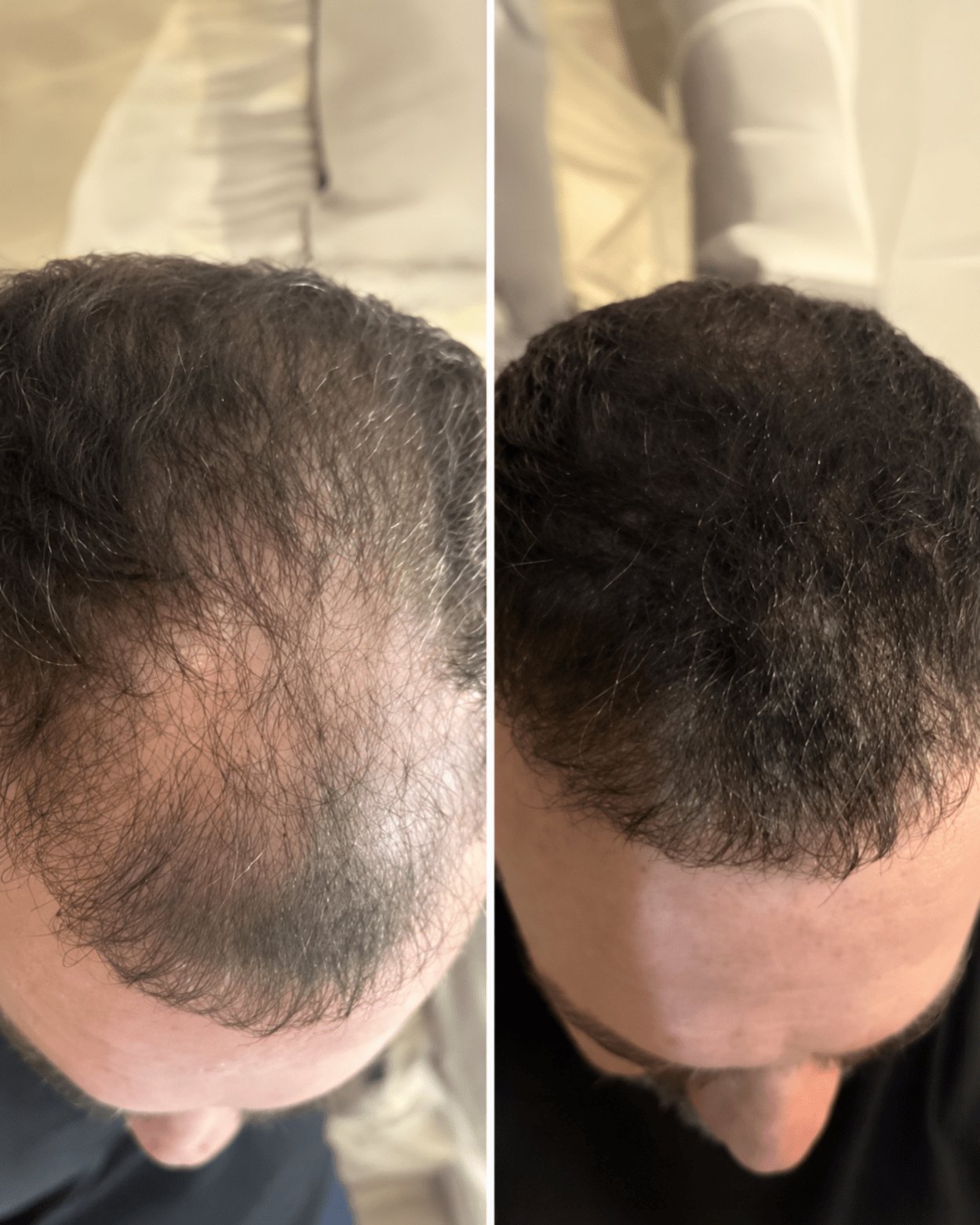 HAIR DENSITY FILLER - Klyr men